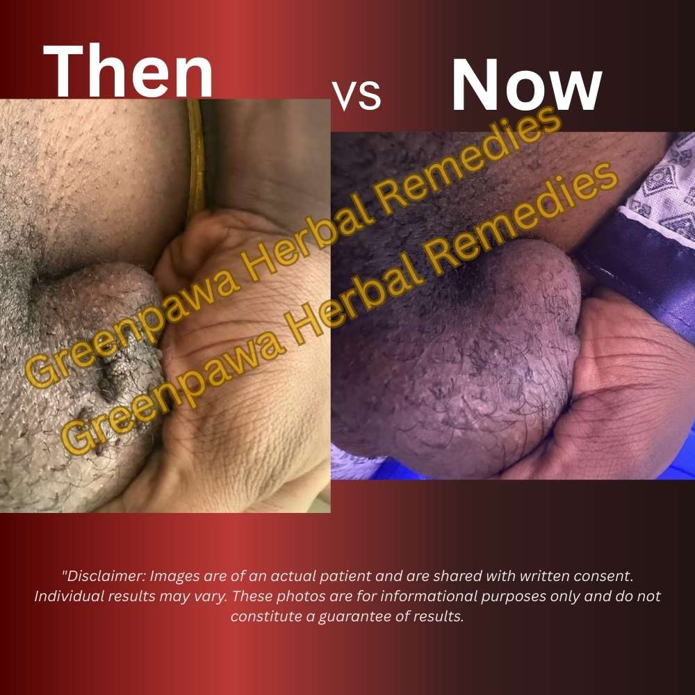 genital wart treatment testimonials