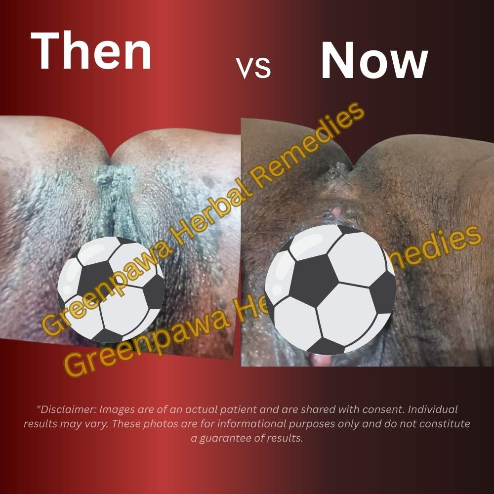 genital wart treatment testimony using Greenpawa Infection Flusher