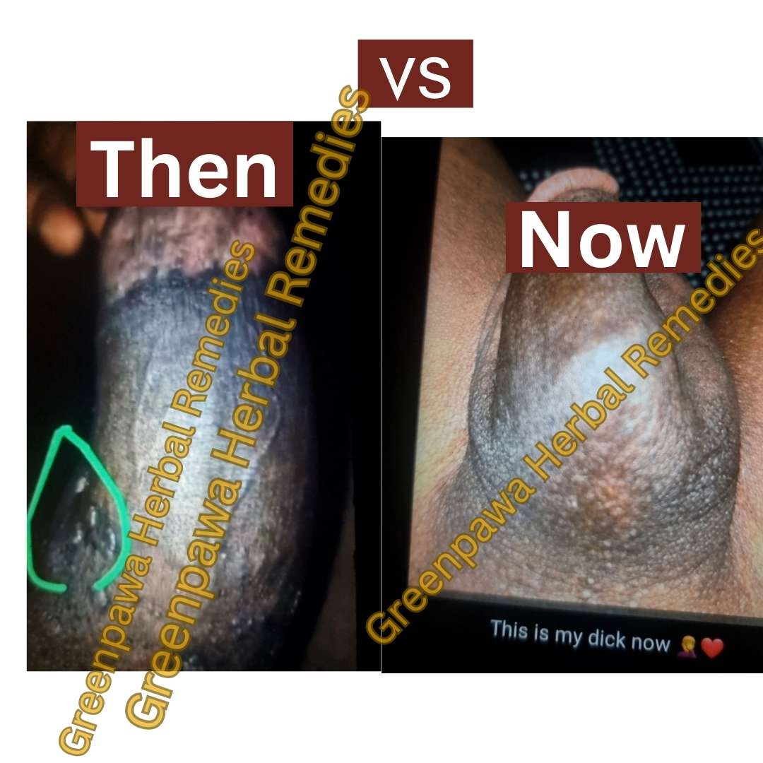 genital warts on dick testimony