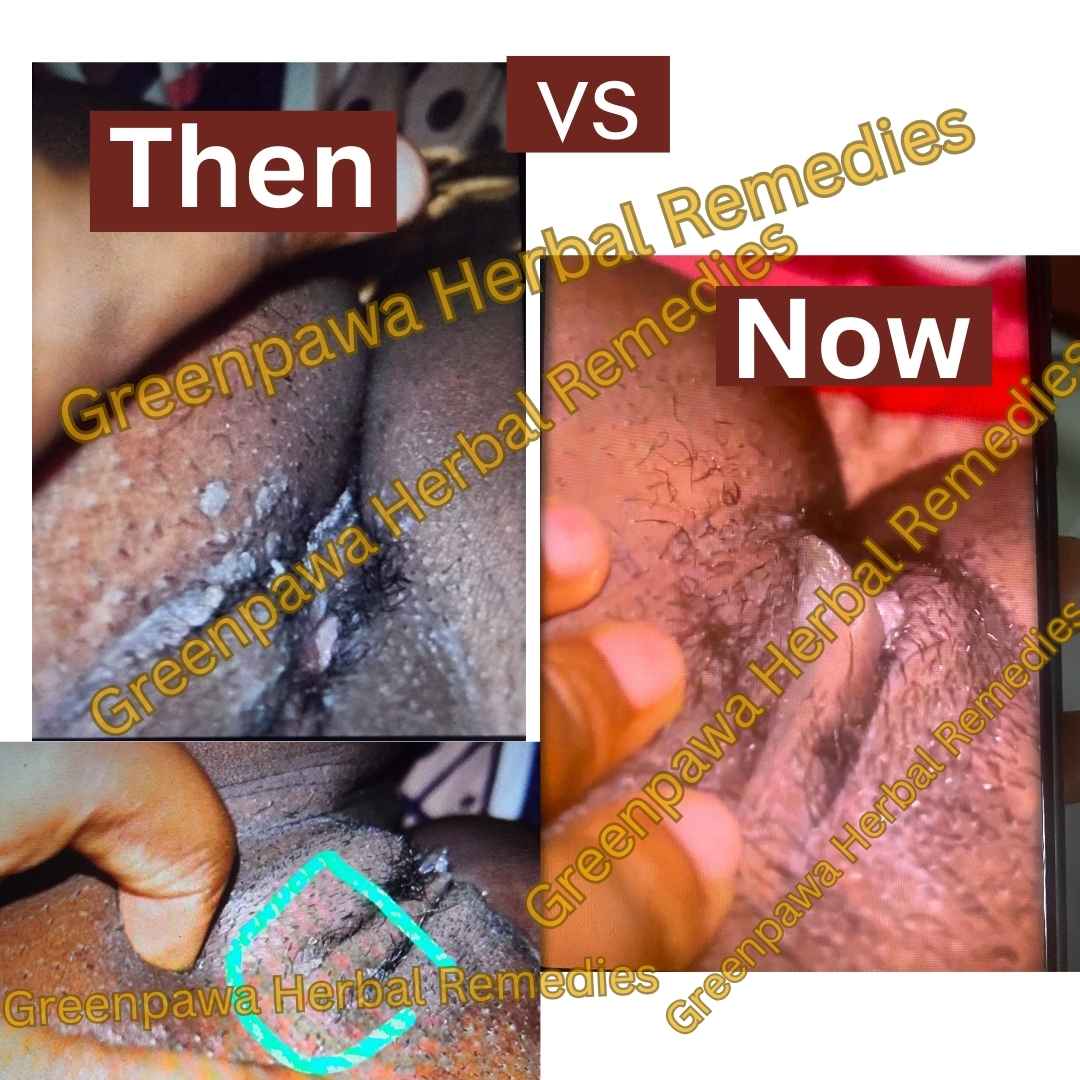 genital warts on vagina testimony